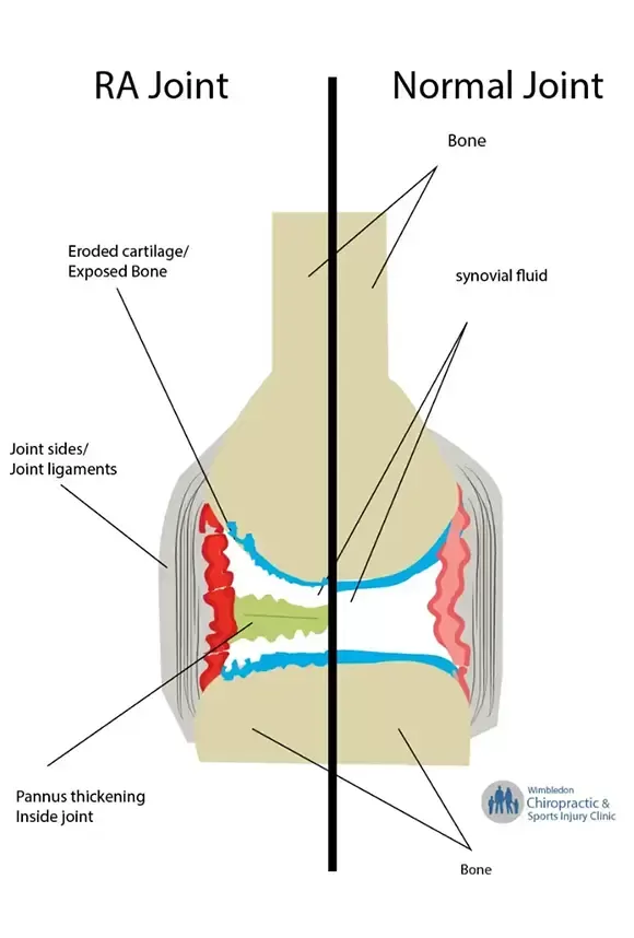 Application in Myofascial Therapy