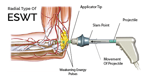 How Shock Therapy Works
