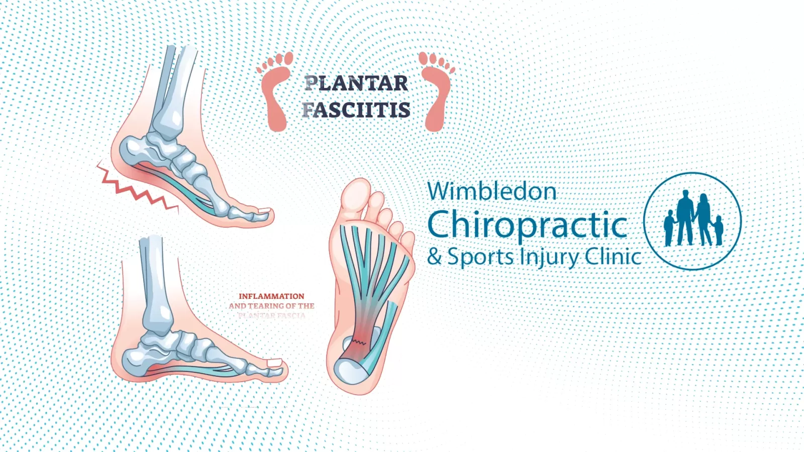 heel pain treatment wimbledon SW19 - Focused shock wave therapy wimbledon SW19