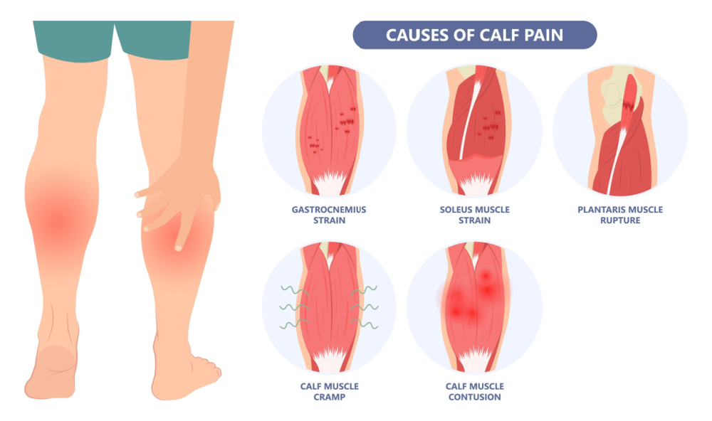 calf strain and tightcalves treatment wimbleodn