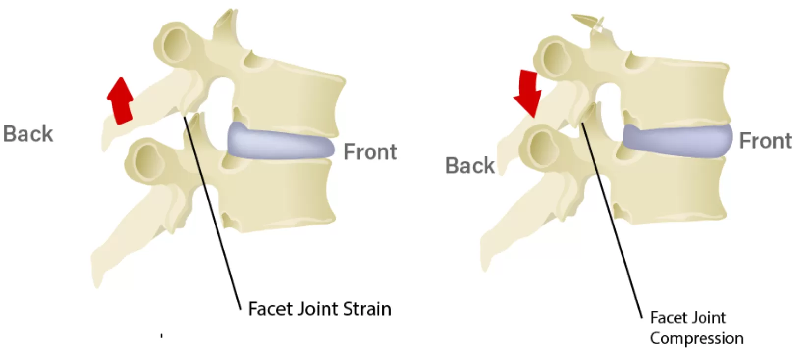 How Does Facet Pain Happen?